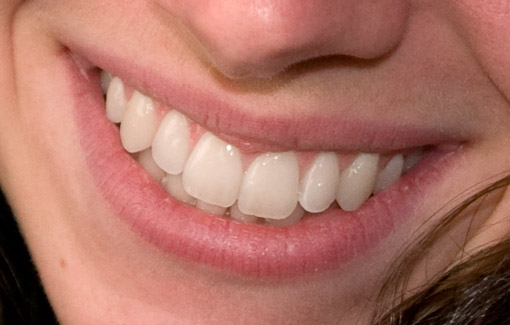 Teeth after Whitening